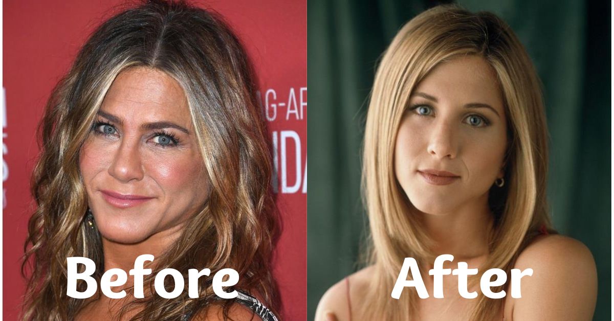 Jennifer Aniston Plastic Surgery