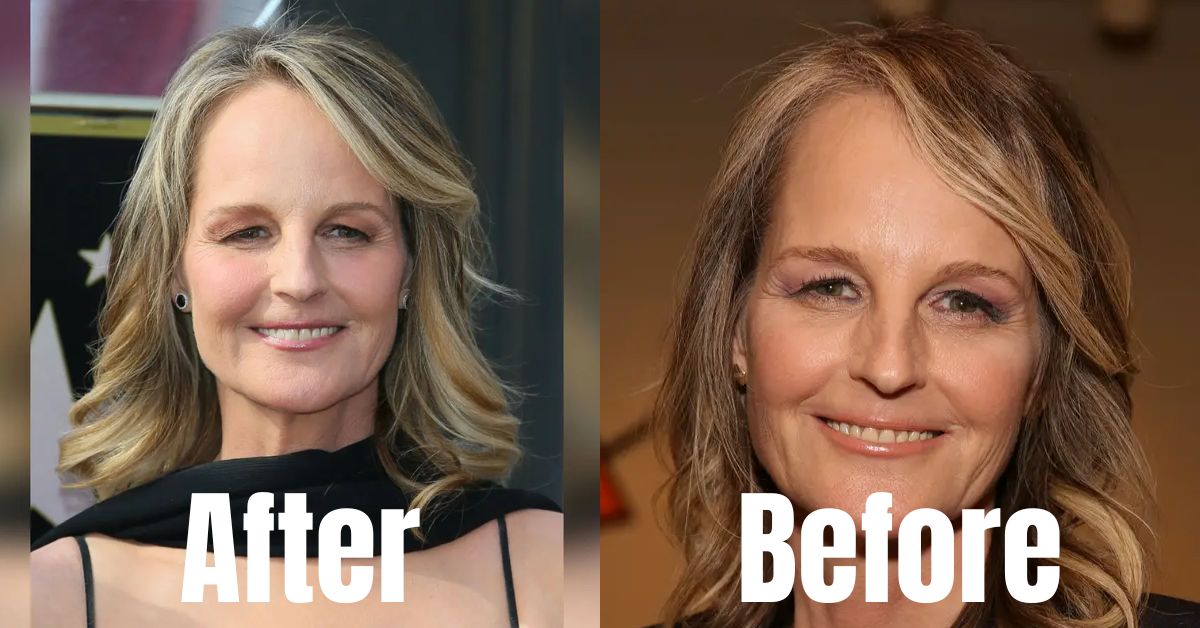 Helen Hunt Plastic Surgery