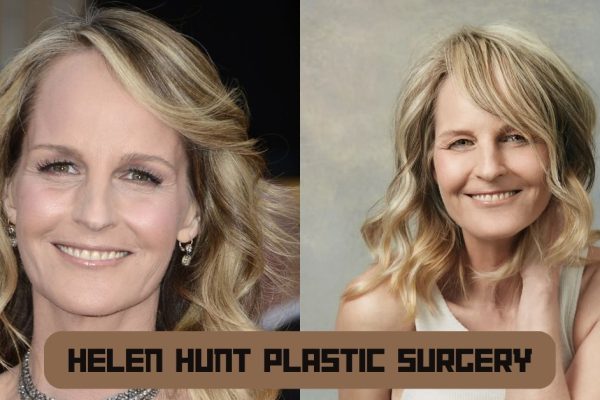 Helen Hunt Plastic Surgery